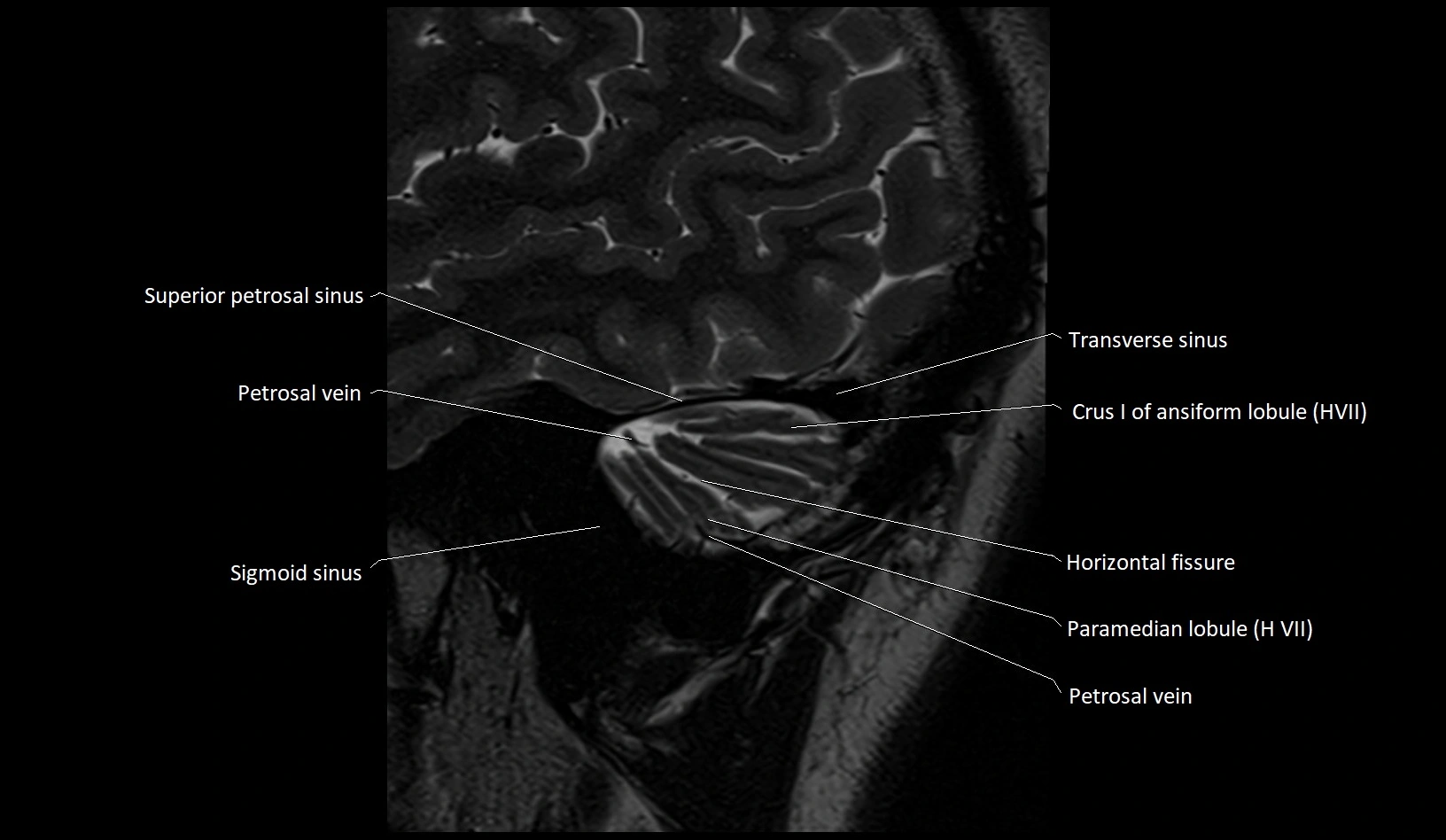 MRI Cerebellar anatomy sagittal High-resolution labelled image 4.webp